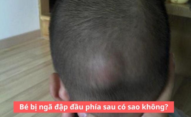 Bé bị ngã đập đầu phía sau có sao không?