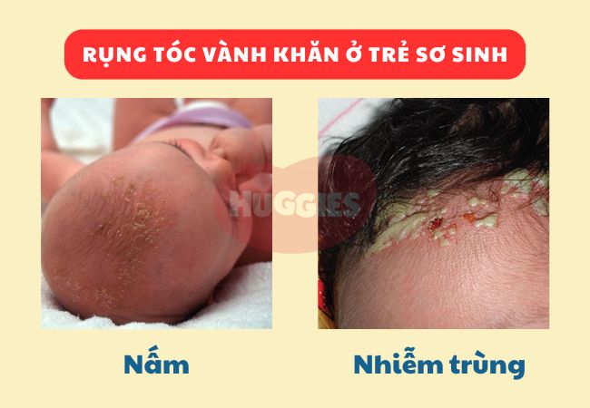 Trẻ bị rụng tóc do nấm và nhiễm trùng da đầu