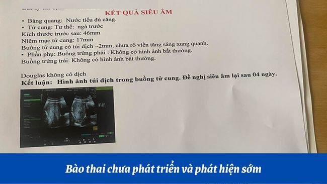 Tại sao siêu âm không thấy thai?