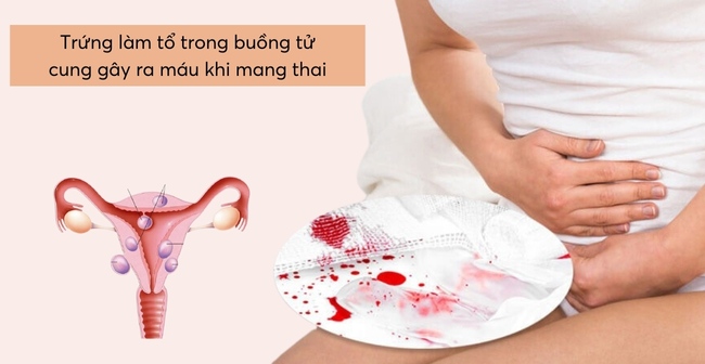 Ra máu màu nâu khi mang thai do trứng làm tổ trong buồng tử cung